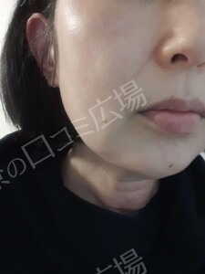治療結果の症例写真