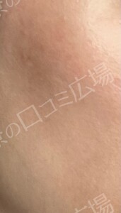 治療直後の症例写真