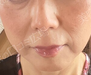 治療直後の症例写真