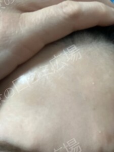 治療前の症例写真