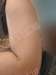 脂肪溶解注射｜エクリリス10ccの治療直後の症例写真