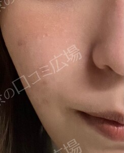 治療直後の症例写真