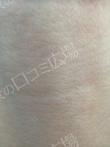治療直後の症例写真