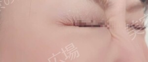 治療直後の症例写真