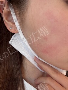 イオン導入｟リピーターOK｠の治療直後の症例写真