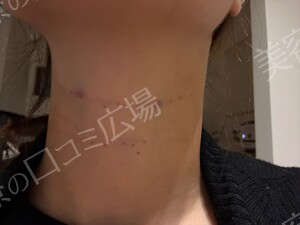 治療直後の症例写真