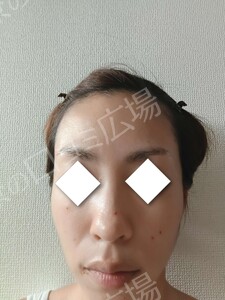 治療直後の症例写真