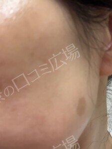 治療前の症例写真