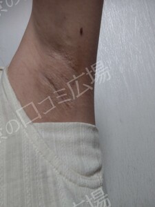 ミラドライ 両わき 1回 レベル８＋部分重複照射の治療結果の症例写真