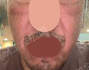 治療直後の症例写真