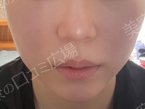 治療直後の症例写真