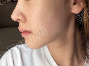 治療直後の症例写真