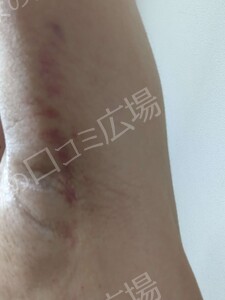 治療直後の症例写真