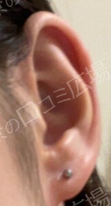 治療直後の症例写真