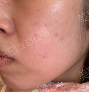 治療直後の症例写真