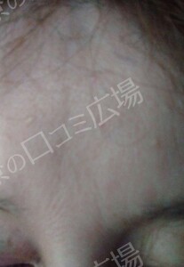 治療直後の症例写真