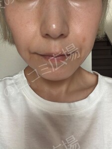 治療直後の症例写真