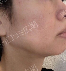 医療ハイフ｜頬・フェイスラインのたるみの治療結果の症例写真