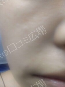 治療直後の症例写真