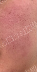治療直後の症例写真