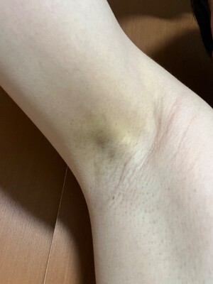 美容皮膚科 町田マリアクリニックのわきが・多汗症治療の症例写真