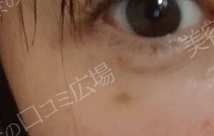 治療直後の症例写真
