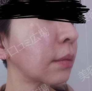 治療直後の症例写真