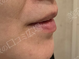 リップアートメイク 2回特別モニター施術｜6.4万円！！の治療前の症例写真