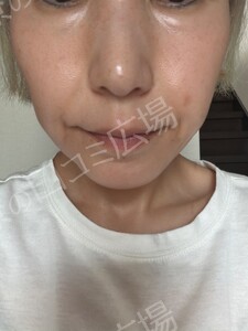 治療直後の症例写真
