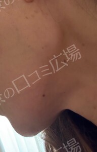 治療結果の症例写真