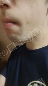 治療前の症例写真