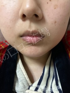 治療結果の症例写真