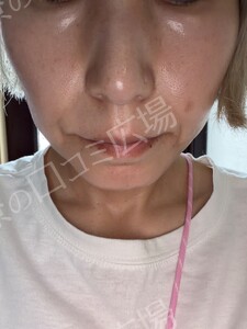 治療前の症例写真