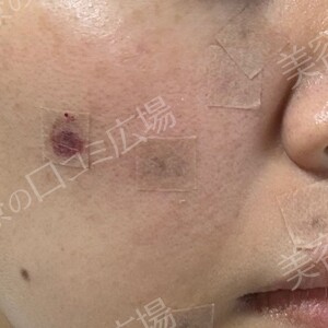 治療直後の症例写真