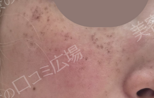 治療直後の症例写真