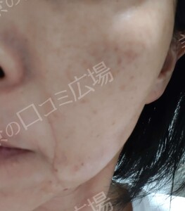 治療前の症例写真