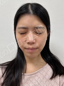 治療直後の症例写真
