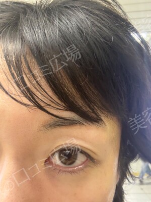 筋肉・美容クリニックのアートメイクの症例写真[ビフォー]