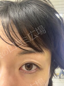 リップ ＆ アイライン上下 アートメイク 2回 モニター施術の治療前の症例写真