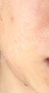 治療直後の症例写真