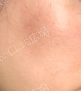 治療直後の症例写真