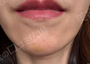 治療直後の症例写真