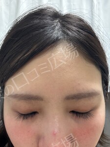 ジェネシスの治療前の症例写真