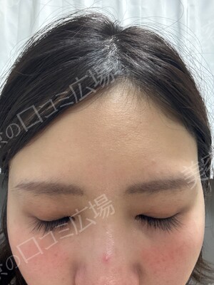 THE CLINIC NAGOYA 【ザ・クリニック名古屋】のシミ・肝斑の症例写真[ビフォー]