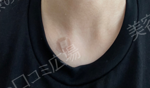 治療直後の症例写真