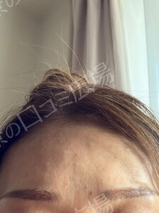 治療直後の症例写真
