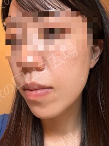 治療直後の症例写真