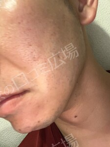 治療直後の症例写真