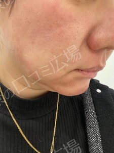 治療直後の症例写真