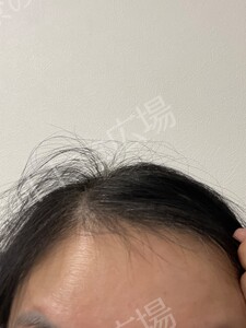 治療直後の症例写真